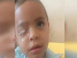 Menina de 2 anos passará por cirurgia após aplicar no olho cola que muita gente tem em casa