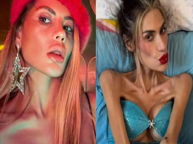 Influencer morre com 22 kg após descobrir distúrbio alimentar