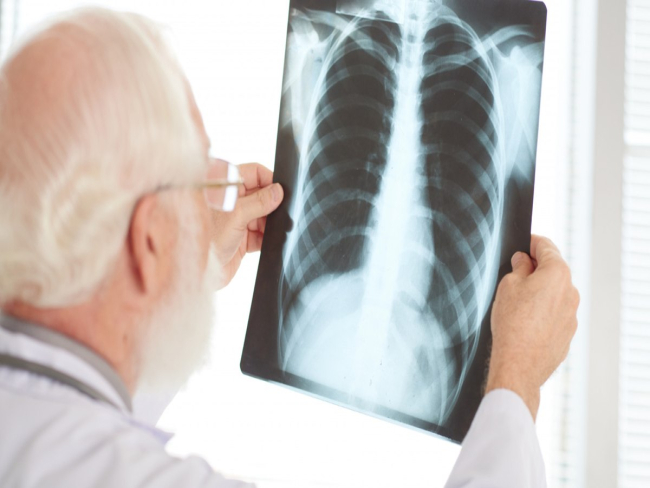 Pneumonia silenciosa: o perigo por trás da doença