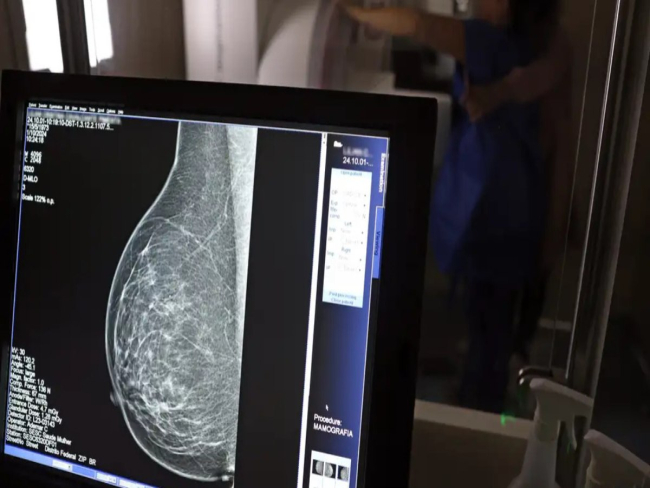 Mamografia no SUS passa a ser oferecida a partir dos 40 anos