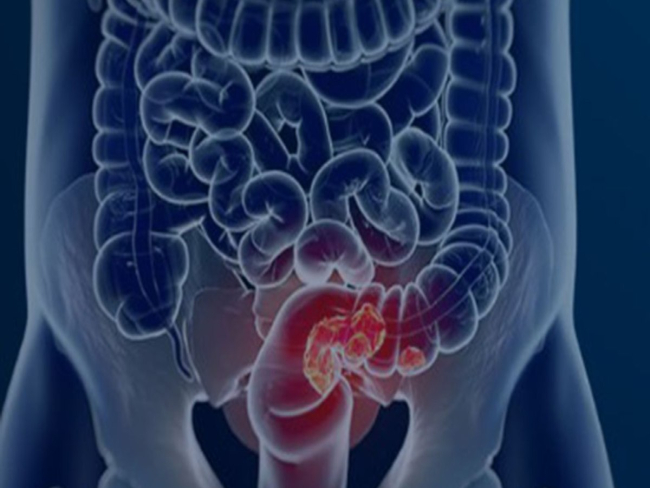 Câmara aprova projeto que inclui prevenção do câncer colorretal