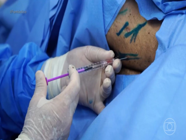 Avanço da polilaminina mira caminho inédito contra a paraplegia