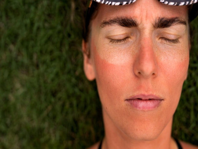 Insolação: Veja como tratar o sintomas e diminuir o calor