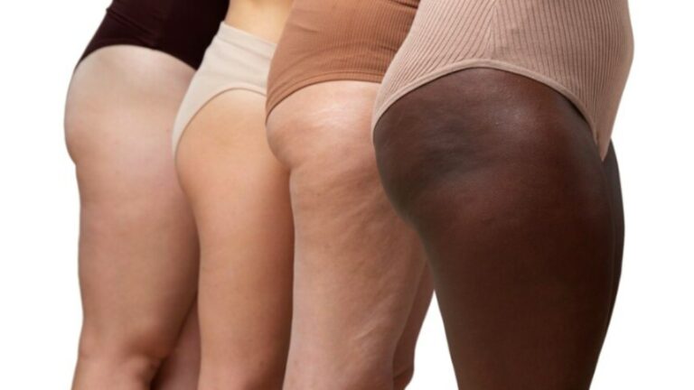 Lipedema ainda desafia diagnóstico e passa despercebido